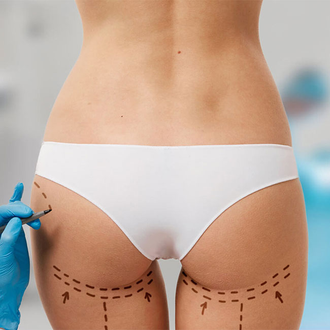 Buttocks Remodelling
