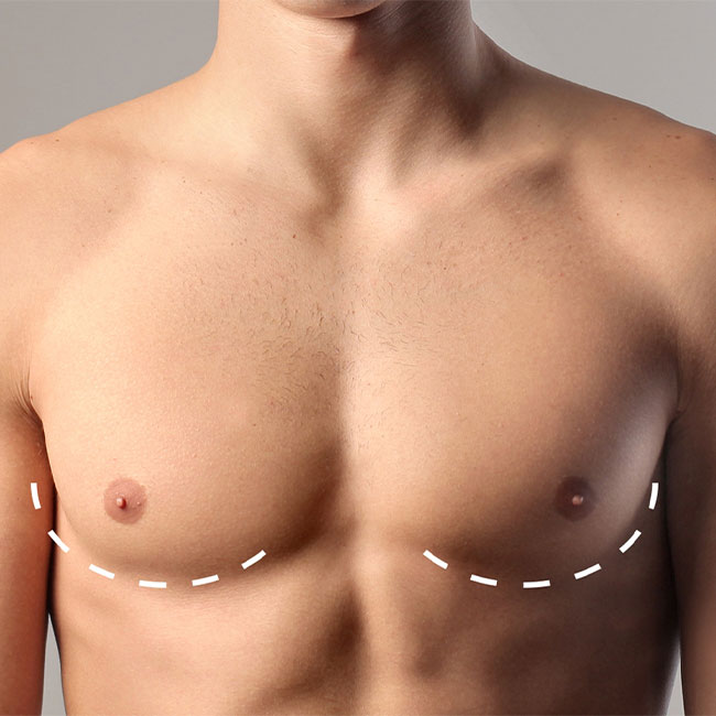 Gynecomastia