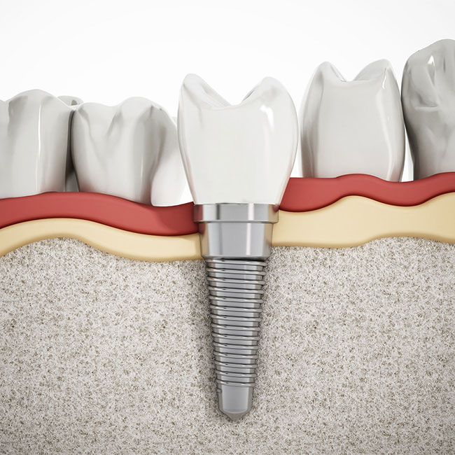 Dental Implant