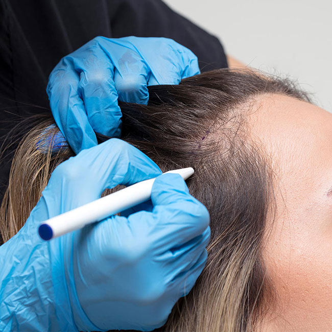 Hair Transplant