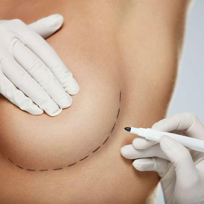 Breast Augmentation