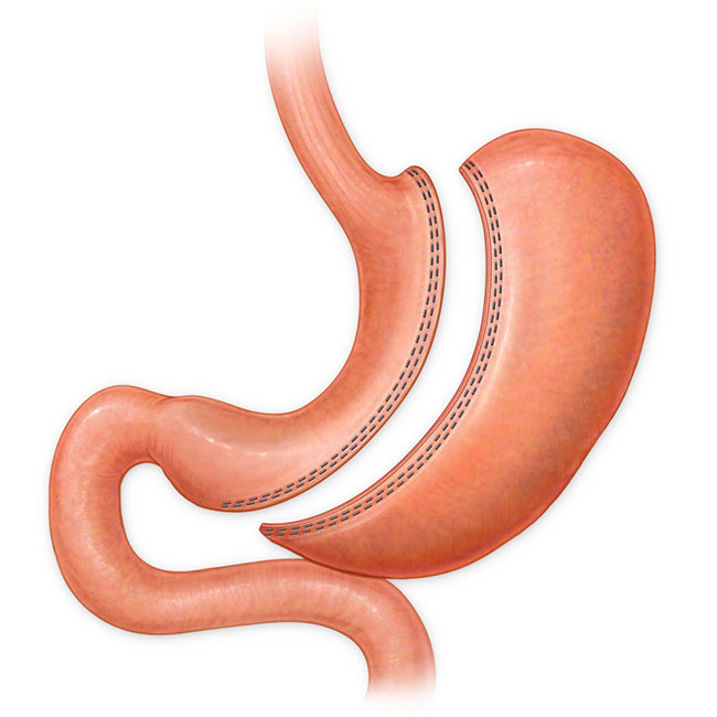Gastric Sleeve