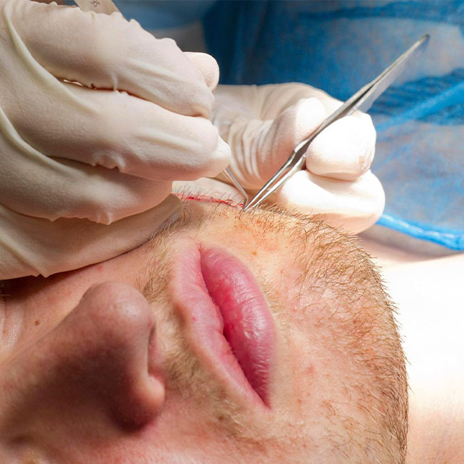 Beard Transplant