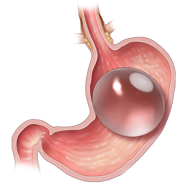 Gastric Balloon