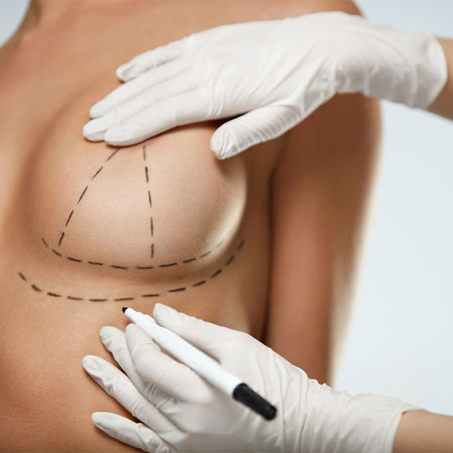 Breast Reduction