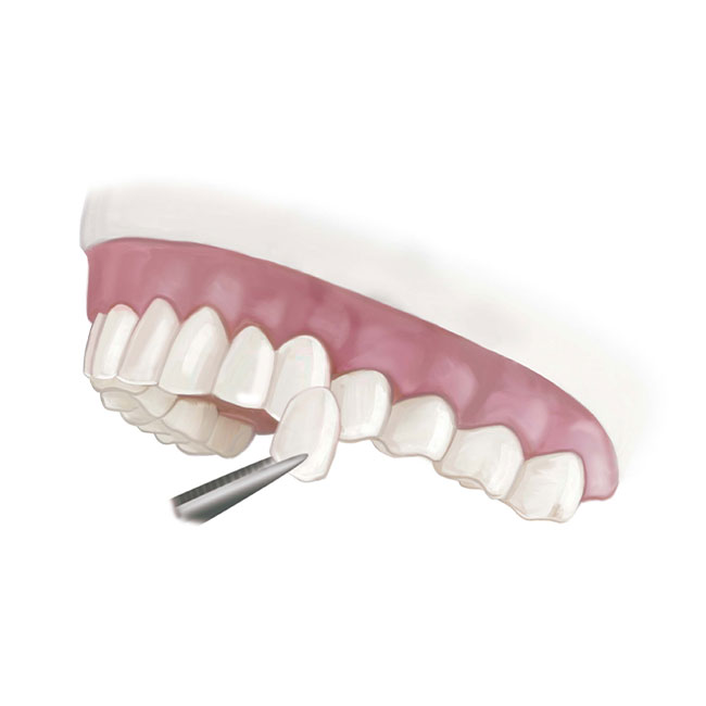 Dental Laminate