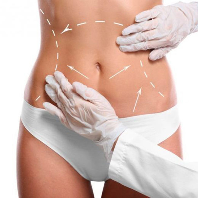 Abdominoplasty