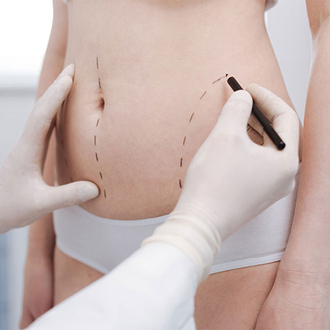 Liposuction