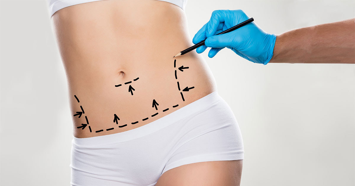 Aesthetic Surgery After Obesity Surgery
