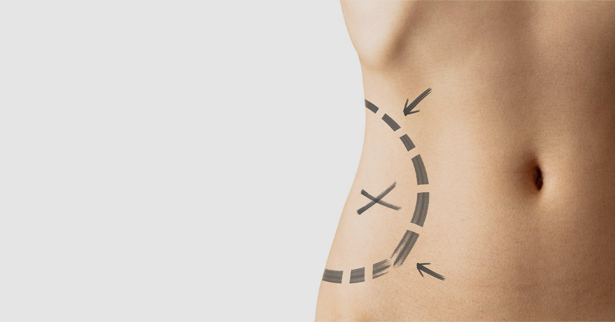 What is Revision Surgery?